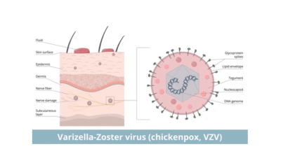 Chickenpox
