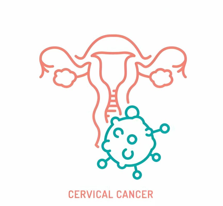 cervical cancer