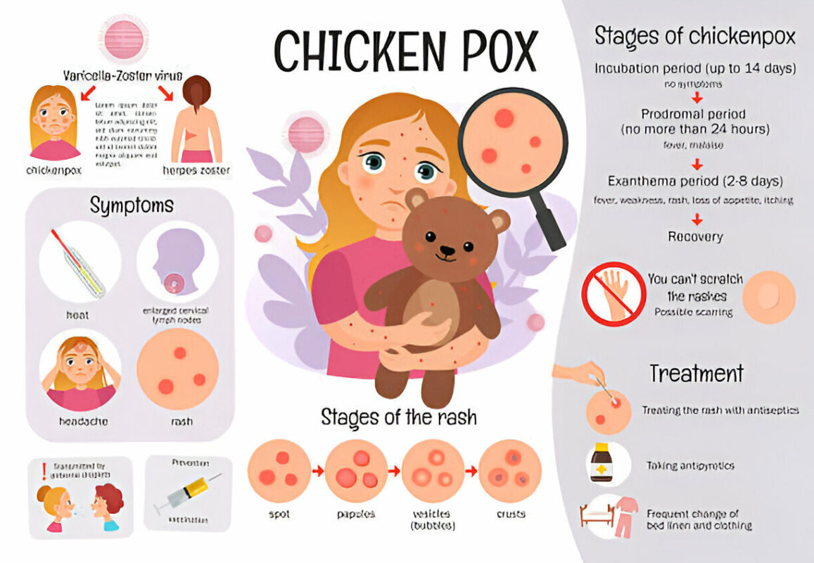 chickenpox vaccine price in bangladesh